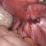 子宫内膜异位北京安太医院治疗特色