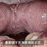 双角子宫北京安太医院融合术产女