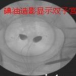 山西双子宫双宫颈患者来京求助