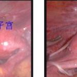 蒋夫人双子宫合并宫颈机能不全的曲折求子路