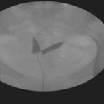 子宫纵隔做试管婴儿也无济于事