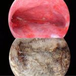 子宫顽固出血自凝射频立止出血