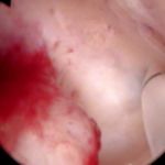 功能性子宫出血无须盲目的切除子宫