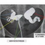 不孕经历之仅一次药流输卵管便关上了“门”