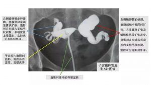 输卵管积水