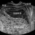 药流后阴道出血一个多月