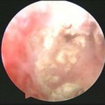 宫腔粘连症状之生育功能障碍