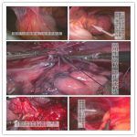 痛经两次开刀造成严重的盆腔粘连