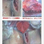 生孩子侧切后发生了会阴裂开