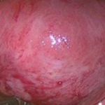 子宫内膜异位之腺肌症的保宫治疗