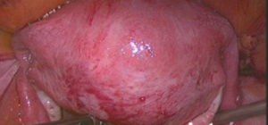 腺肌症,盆腔粘连