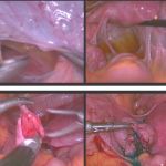 盆腔粘连真实经历之一次开腹后悔一辈子