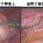盆腔粘连是不孕症的隐形坏分子