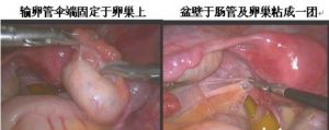 多囊卵巢,盆腔粘连