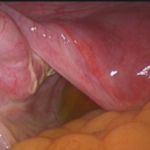 人流后盆腔粘连七年不孕 北京安太医院一时便解