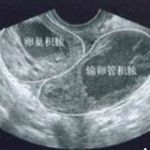 盆腔炎输卵管积脓三D腔镜最彻底!