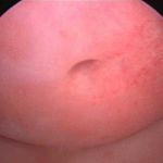 阴道纵隔阻断了她的性“路”