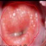 宫颈治疗液“安太液”真神奇