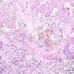 外阴白斑常做检查