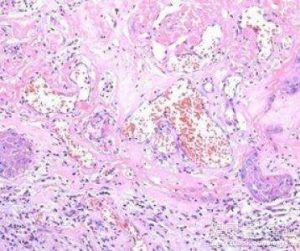 外阴白斑常做检查