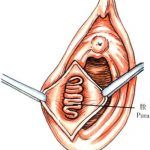 前庭大腺囊肿保守治疗效果不好