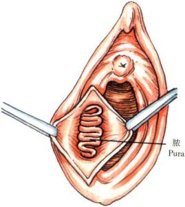 前庭大腺囊肿