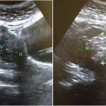 她觉得前庭大腺囊肿和生孩子有关系