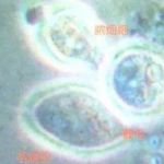 细菌性阴道病检查