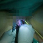 晚期流产的症状有哪些?