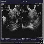 宫颈机能不全的先天性因素