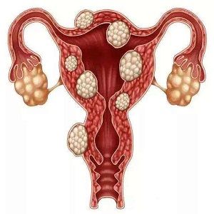 子宫内膜息肉治疗原发病