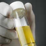 妊娠剧吐尿液检查