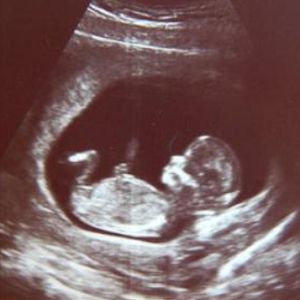 妊娠12周B超图