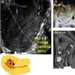 子宫内膜息肉和增生的诊疗标准