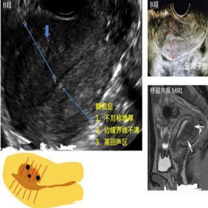 子宫内膜息肉和增生的诊疗标准