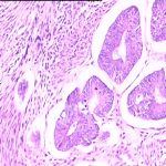 子宫腺肌症病理检查