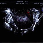 子宫腺肌症没有症状?