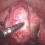 子宫腺肌症病灶清除保宫治疗