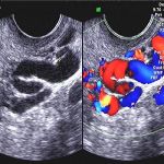 子宫腺肌症U型保宫术