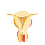 腺肌症与曼月乐