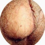 前庭大腺囊肿-难言的痛