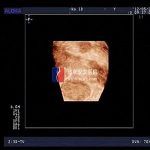 石女全景四维彩超检查