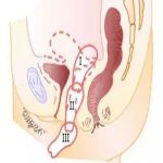 盆底松弛综合症的常规检查
