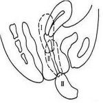 阴道松弛有什么害处？