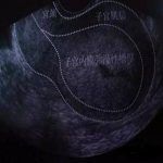 子宫内膜增生息肉超声检查