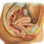 张力性尿失禁治疗新方法