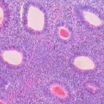 子宫内膜增生息肉症状之子宫不规则出血