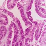 子宫内膜增生息肉病理检查