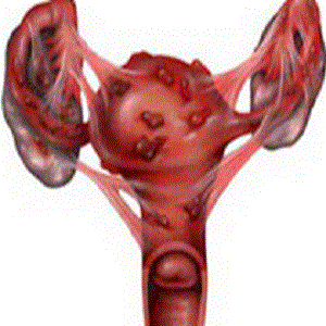 子宫内膜异位图片
