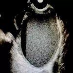 前庭大腺囊肿急诊治疗